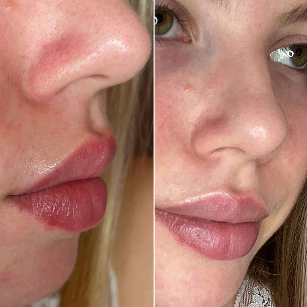 PoreClear™ Nose Patches