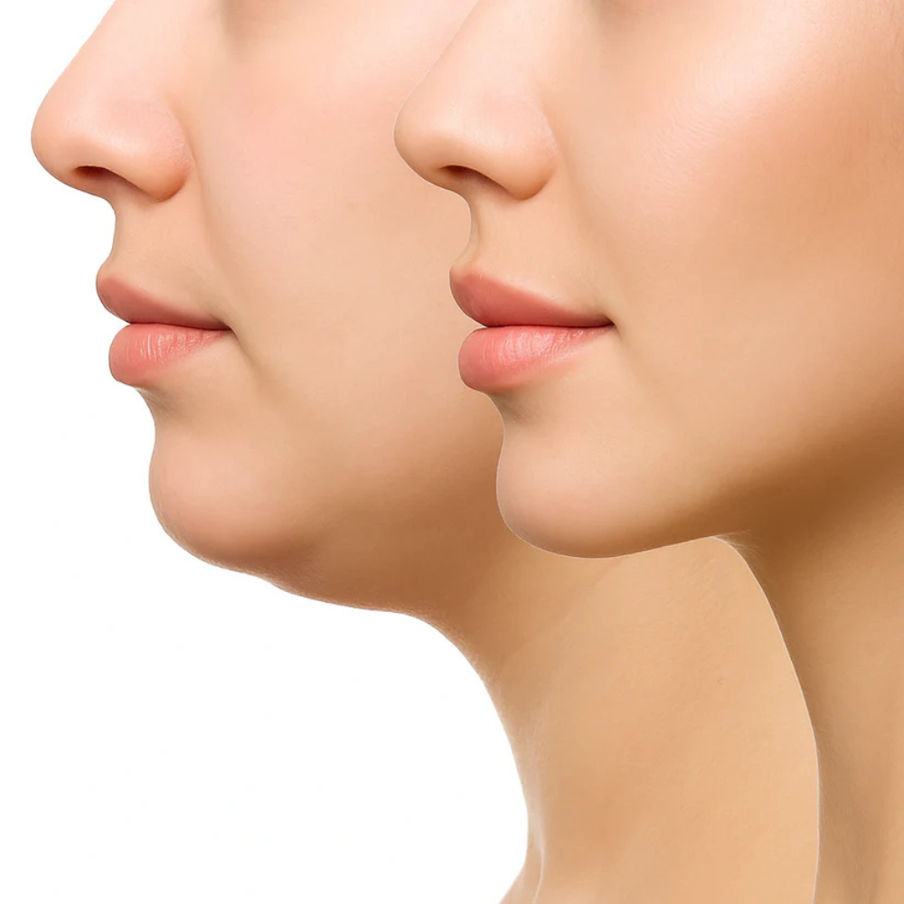 VShape™ | Face Slimming Strap