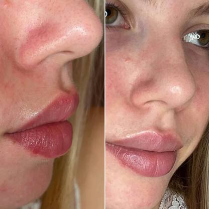 PoreClear™ Nose Patches