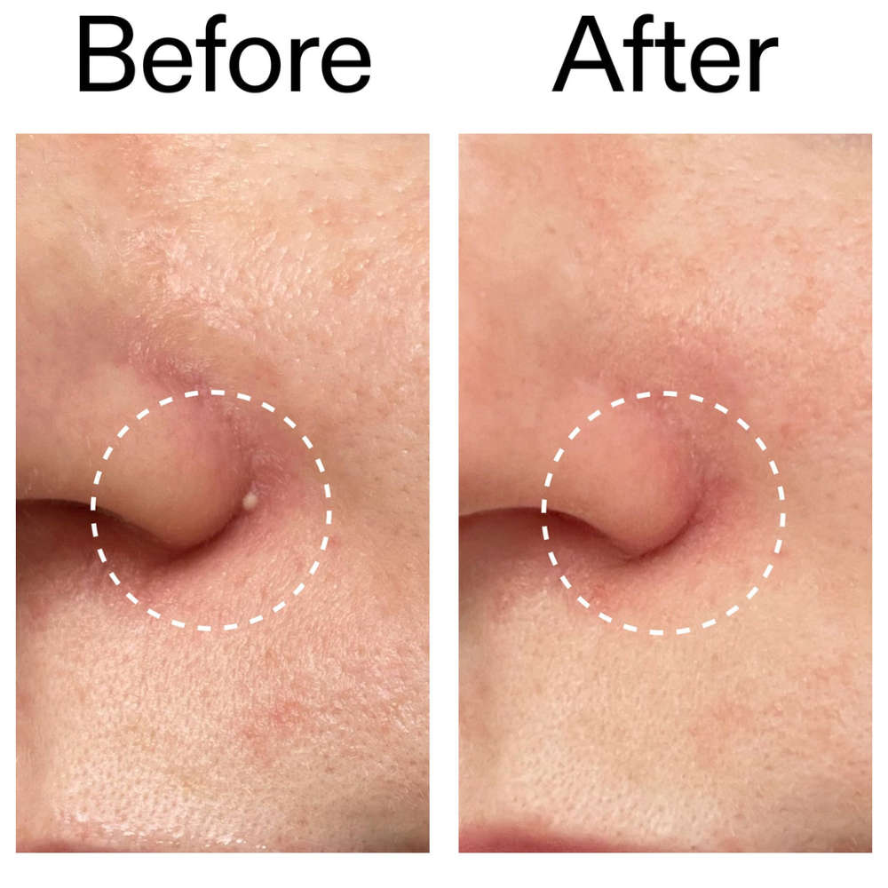 ClearDot™ | Invisible Pimple Patch