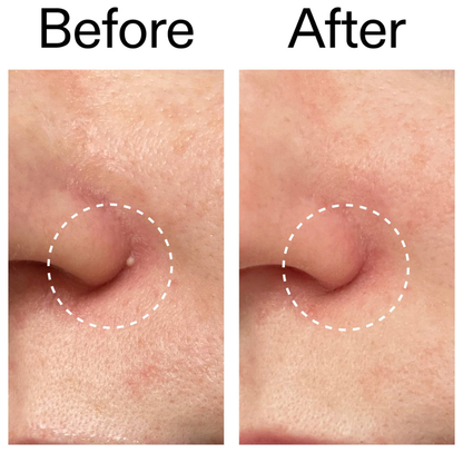 ClearDot™ | Invisible Pimple Patch