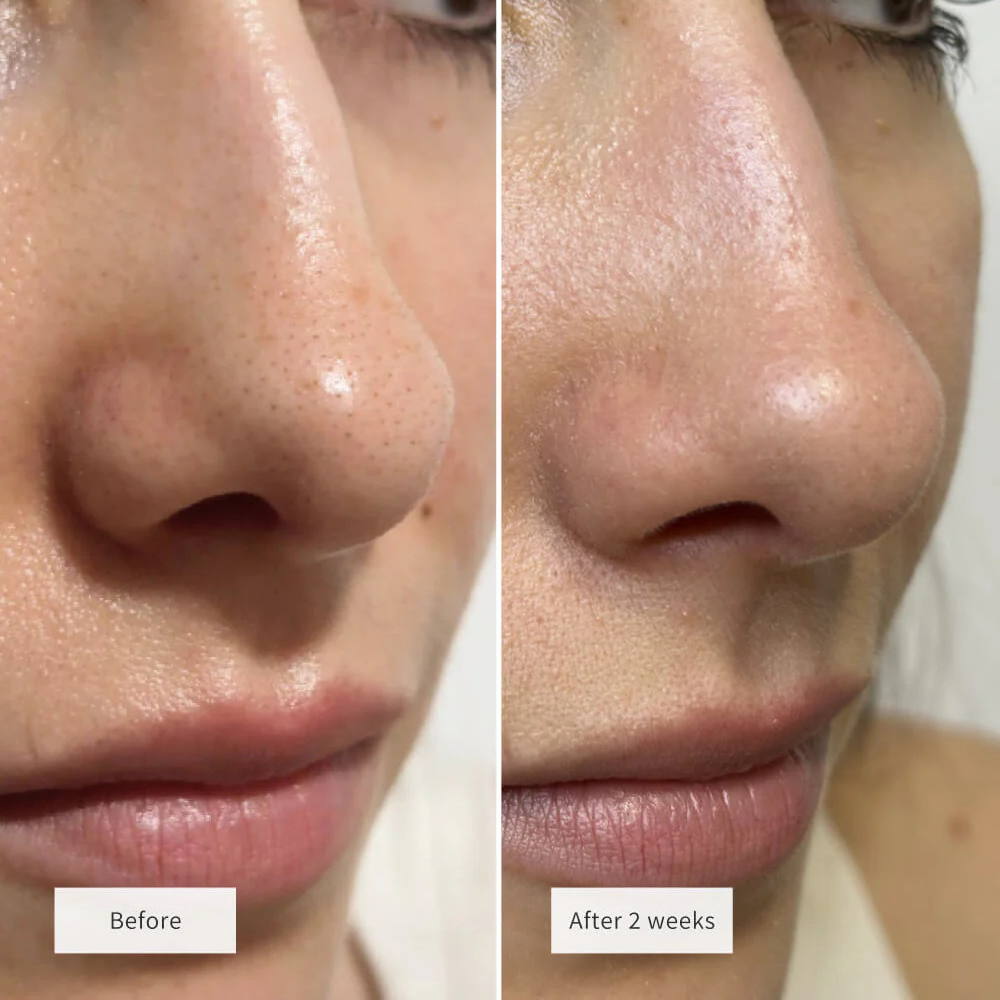 PoreClear™ Nose Patches