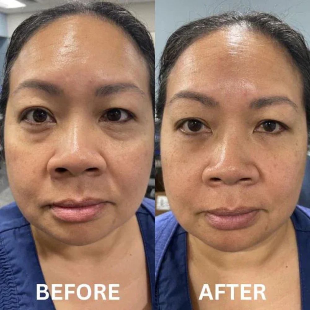 Refresh&Hydra™ | Collagen Eye Patches