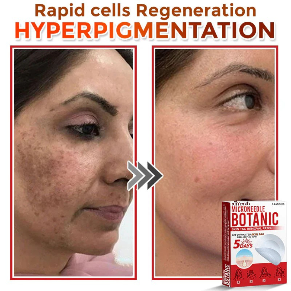 RenewTag™ | Skintag Removal Patches