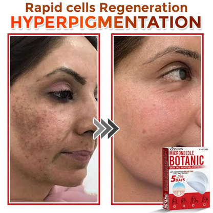 RenewTag™ | Skintag Removal Patches